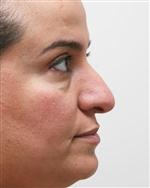 'Öğle Arası' Burun Estetiği