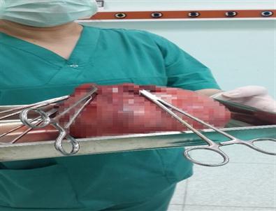 Rahminden Dört Kiloya Yakın Cisim Çıkarıldı