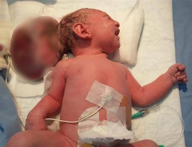 İkiz Kafalı Doğan 5 Günlük Bebeğe Ameliyat