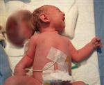 ERDAL KALKAN - İkiz Kafalı Doğan 5 Günlük Bebeğe Ameliyat