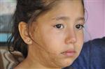 (özel Haber) 8 Aylıkken Yüzü ve Omzu Yanan Küçük Pınar Tedavi Olmak İstiyor
