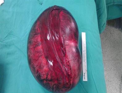 (özel Haber) Karnından 5 Kilo Kitle Çıkarıldı