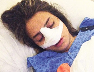 Ceyda Ateş'in burnu kırıldı