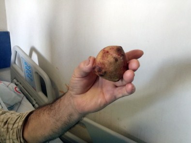 Çaycuma Devlet Hastanesi'nde Başarılı Ameliyatla Sağlığına Kavuştu