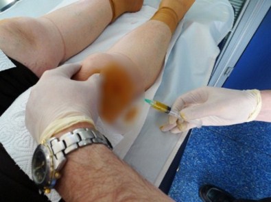 Diz Kireçlenmesinde Prp Tedavisinde Bunlara Dikkat