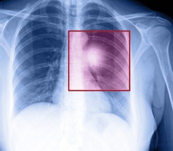 Doç. Dr. Kılıçkap Açıklaması 'Son 5 Yılda Akciğer Kanserine Yönelik Daha Etkili Tedaviler Geliştirildi'