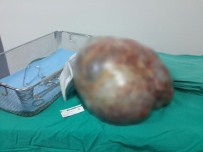 NECATİ KAYA - Karın Ağrısıyla Gitti, Futbol Topu Büyüklüğünde Ur Çıktı