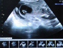 GEBELİK TAKİBİ - Gebelik zehirlenmesine detaylı ultrason ile erken teşhis