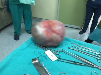 Karnından 4 Kiloluk Kitle Çıkartıldı