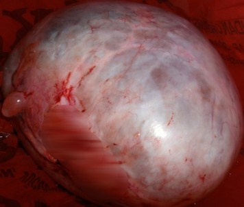 Bir Kadının Rahminden Alındı Açıklaması Tam 5 Kilo !