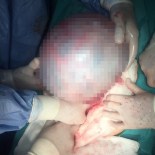 Karpuz Büyüklüğündeki 5 Kiloluk Kist Şaşırttı