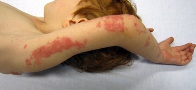 Zona Hastalığına Dikkat