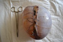 Bu Bir İnsanın Karnından Çıktı !