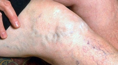 Varislerin Bitkisel Tedavisi