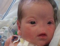 İMPLANT - Dünyaya burunsuz geldi