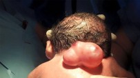 OMURİLİK - Omuriliği Dışarıda Doğan Bebek, Doğumundan 8 Saat Sonra Ameliyat Edildi