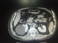 BÖBREK AMELİYATI - Böbrek Kistlerine Laparoskopik Çözüm