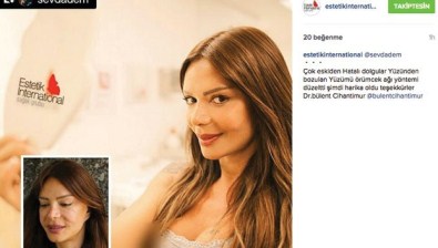 Sevda Demirel Örümcek Ağı Estetiği Yaptırdı