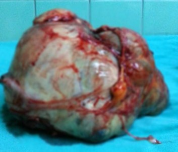 Basketbol Topu Büyüklüğünde !