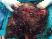 Yaşlı Kadının Karnından 5 Kilolok Tümör Çıktı