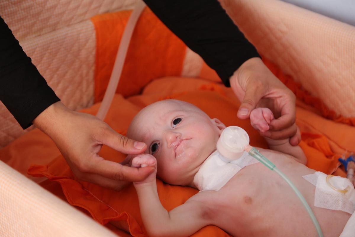 6 aylık bebek 6 kere ameliyat oldu