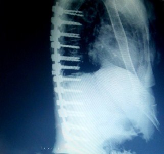 Edremit'te Bir Hastaya Erimeyen Platinden Omurga Yapıldı