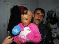 YÜZ NAKLI - Mülteci Çocuğun Dramı