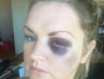 Damat nedimeyi hastanelik etti