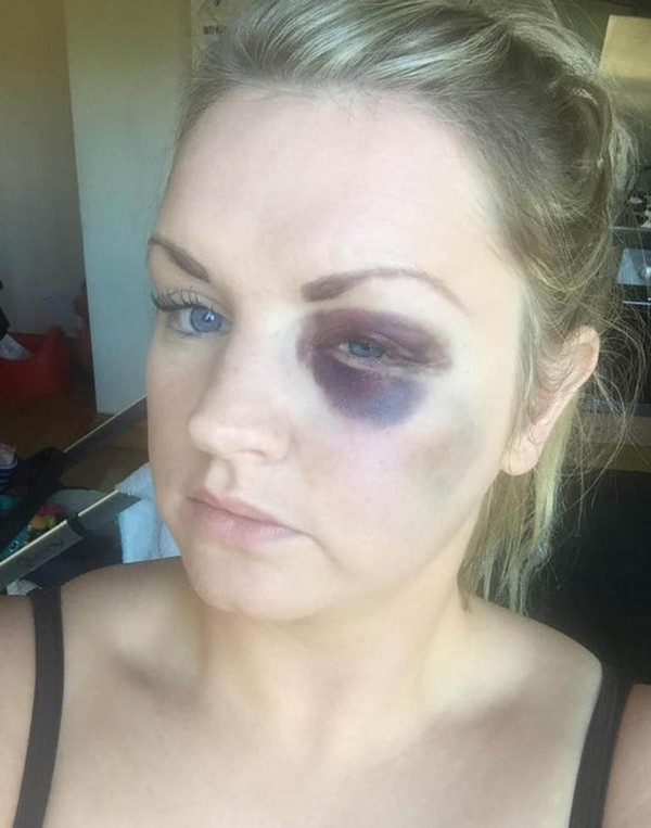 Damat nedimeyi hastanelik etti