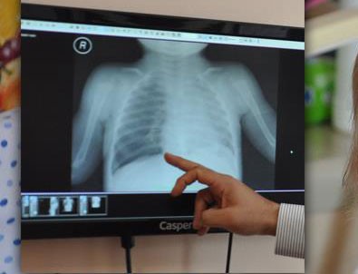 Akciğerinden çıkan 'nohut' şaşırttı