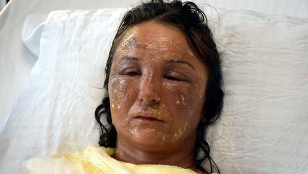 Tekirdağ'da uyuyan gelinin yüzüne kızgın yağ döktü