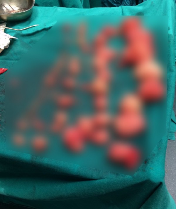 Şişen karnından çıkanlar şaşırttı