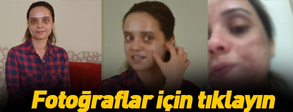 Lekelerden kurtulmak isterken genç kızın yüzü yandı!