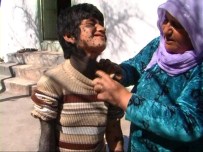 FATIH AKSOY - 10 Yaşındaki Suriyeli Kızın Dramı Yürek Burkuyor