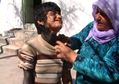 Suriyeli Kızın Dramı ! Yardım Bekliyor