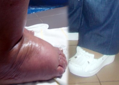 31 Yıl Sonra İlk Kez Ayakkabı Giydi