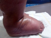 (Özel) 31 Yıl Sonra Fil Hastalığını Yendi İlk Kez Ayakkabı Giydi