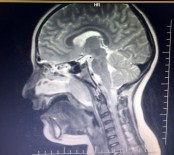 SAĞLIKLI HAYAT - Geniz ETİ Çocuklarda Uyku Ve Solunum Zorluğuna Yol Açıyor