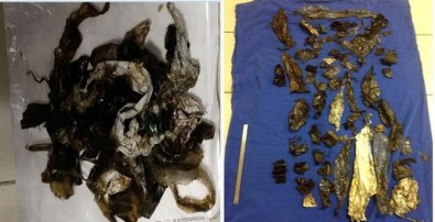 Midesinden 52 Naylon Poşet Parçası Çıkarıldı