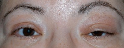 Göz Kapağı Düşüklüğüne Dikkat