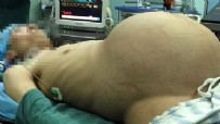 HAMİLE KADIN - Karnından 15 kiloluk tümör çıktı