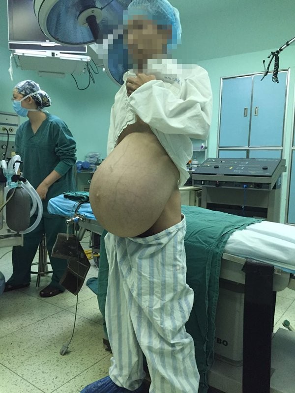 Karnından 15 kiloluk tümör çıktı