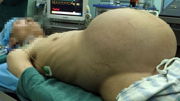 Karnından 15 kiloluk tümör çıktı