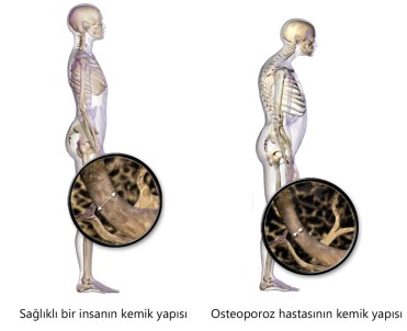 Kemik Erimesinden Korunmak İçin Ne Yapmalı ?