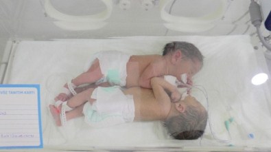 Şanlıurfa'da Aynı Karaciğere Sahip Siyam İkizleri Dünyaya Geldi