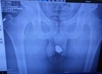 Çaldığı Ziynet Eşyaları Röntgenle Ortaya Çıktı