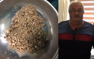 Bu Taşlar Böbreğinden Çıktı