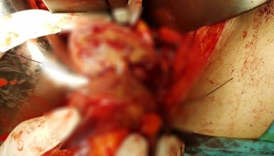 Böbreğinden 550 Gramlık Tümör Çıkarıldı