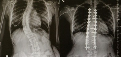 Omurga Eğriliği Olanlar OMÜ'de Şifa Buluyor