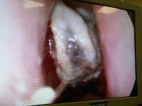 Yozgat'ta  5 Yaşındaki Kız Çocuğunun Burnundan Zeytin Çekirdeği Çıkartıldı